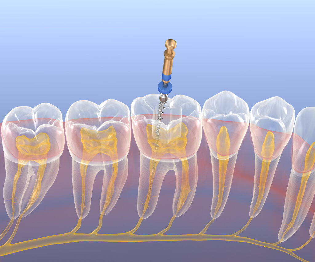 londonderry root canal