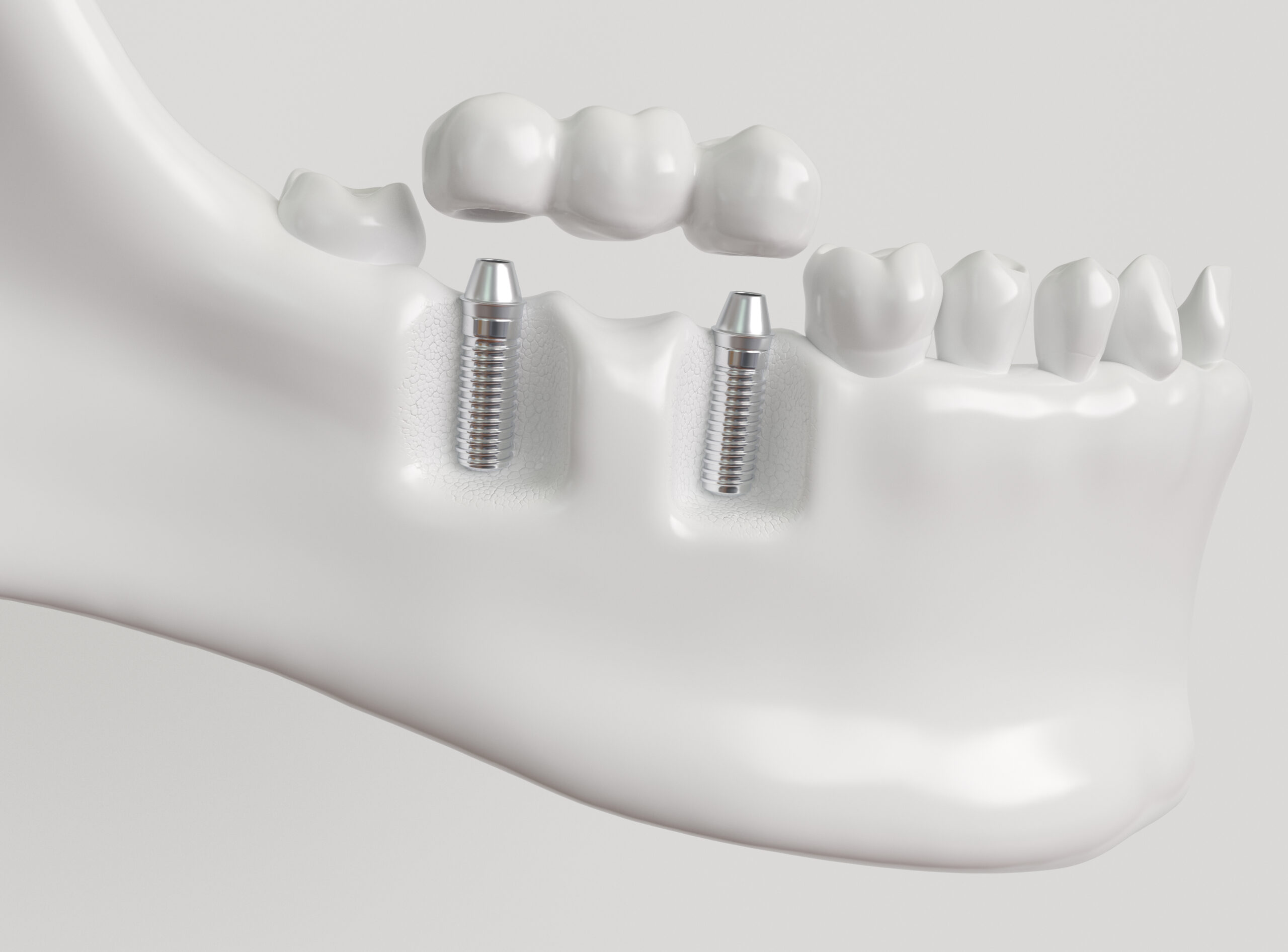 Spring Tooth Nh Supporting Bridges To Treat Tooth Loss | Londonderry, NH