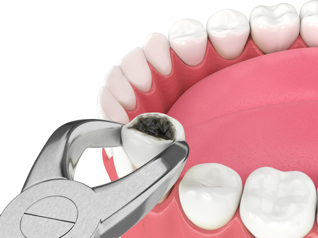 londonderry tooth extraction