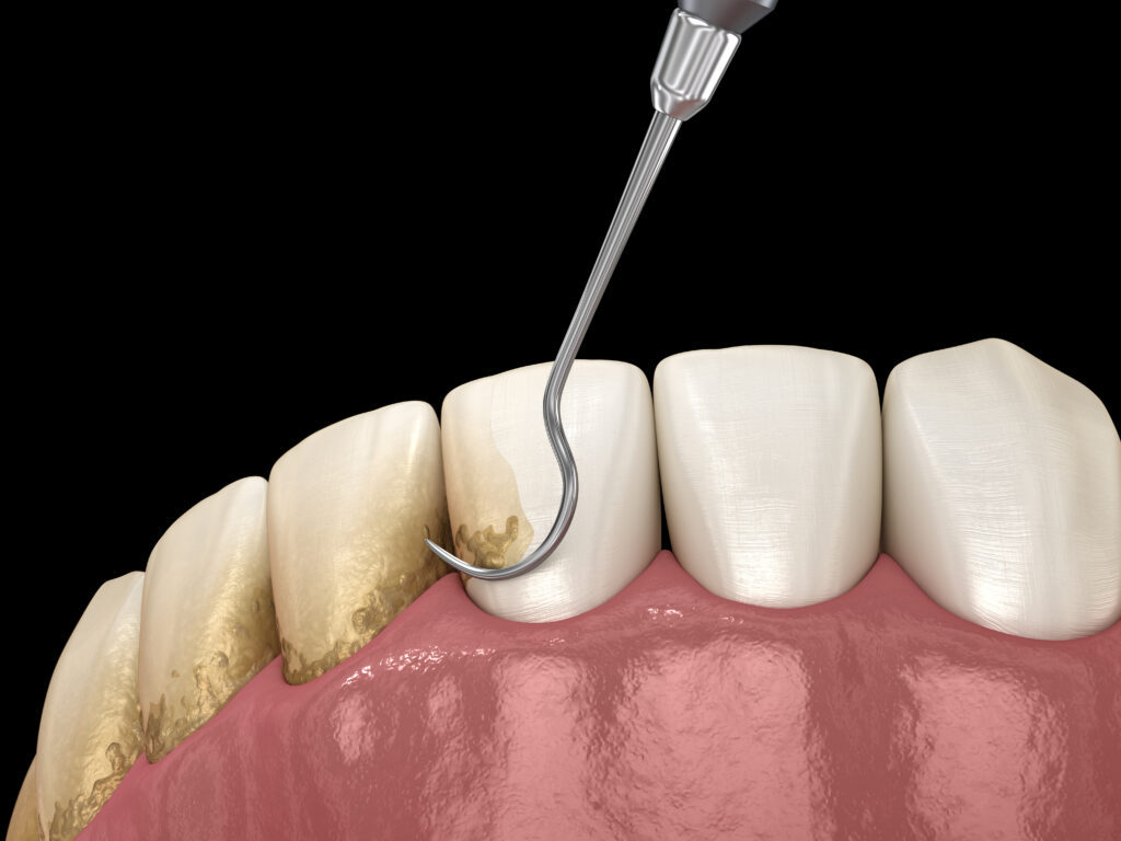 londonderry ultrasonic scaling