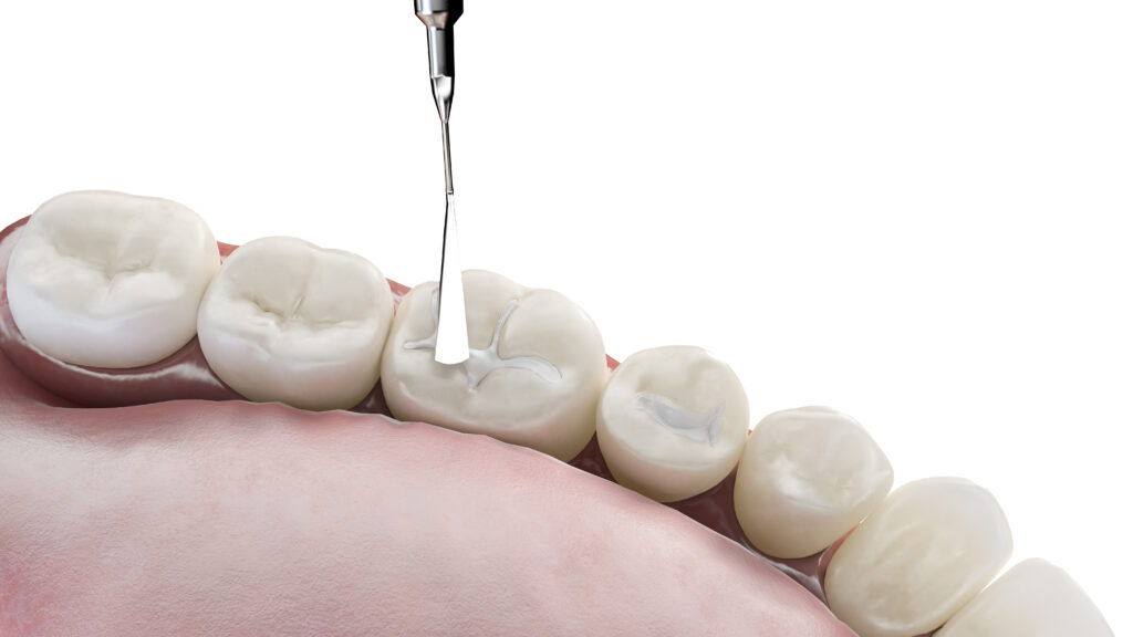 londonderry dental fillings